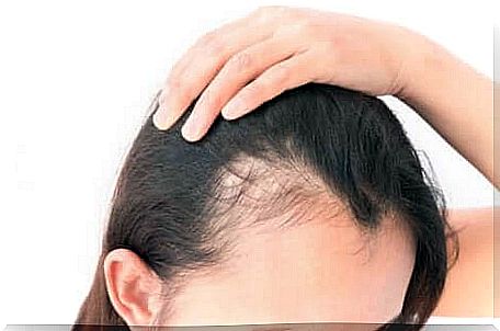 In the most common forms of alopecia in women, the hairline will remain untouched by the condition.