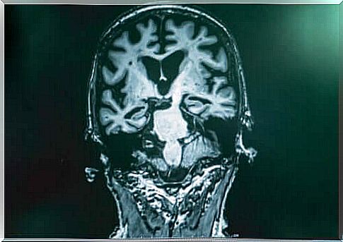 X-ray of brain.